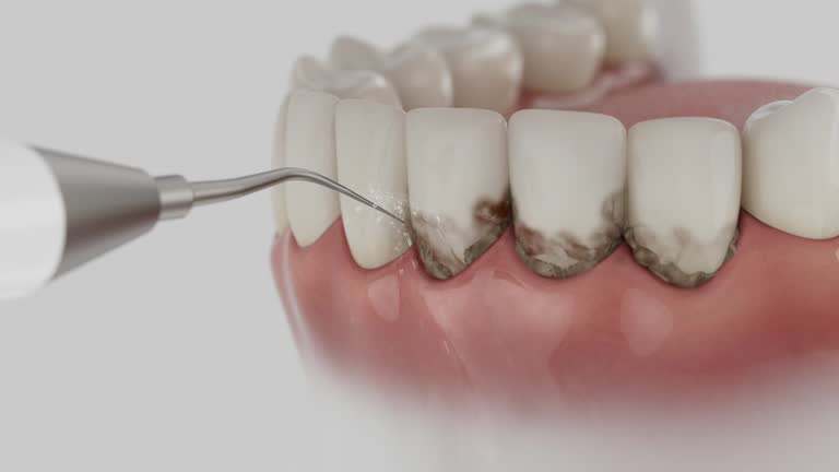 Reliable Wisdom Tooth Removal contractor in Pemberwick, CT by Smile Center Dentistry